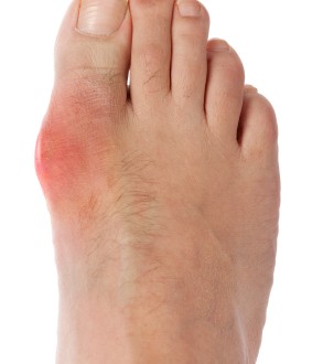 Natural Remedies for Gout  Off The Grid News
