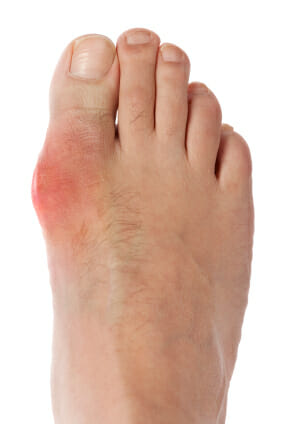 Natural Remedies for Gout