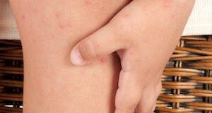 How To Naturally Kick Eczema To The Curb