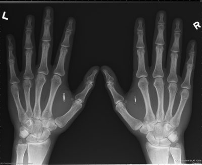 ‘Apocalyptic’ Microchip Implants Are Here – And Being Inserted Into People’s Hands