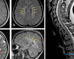 Rethinking Multiple Sclerosis: Could Parasitic Brain Worms Be Misdiagnosed?